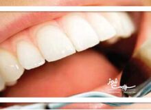 لبخند تقلبی به قیمت سلامت دندان