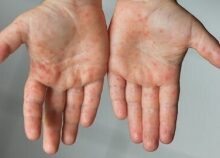 سرخک در کشور شیوع پیدا نکرده است