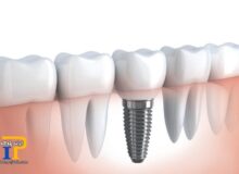 چه کسانی می‌توانند از ایمپلنت دندانی استفاده کنند