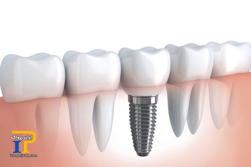 چه کسانی می‌توانند از ایمپلنت دندانی استفاده کنند