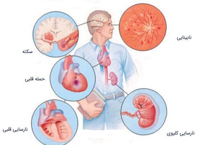 طب سنتی یاریگر کنترل پرفشاری خون/اصلاح سبک زندگی نخستین گام