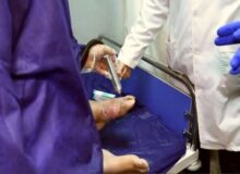 پلاسما درمانی ۱۵۰۰ بیمار مبتلا به زخم دیابتی در کرج